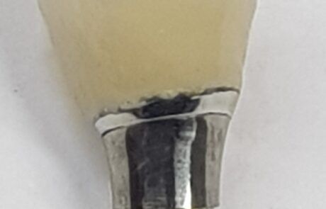 Prótesis dental