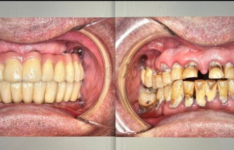 Prótesis dental