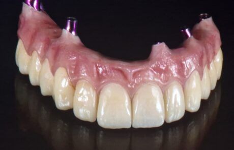 Prótesis dental