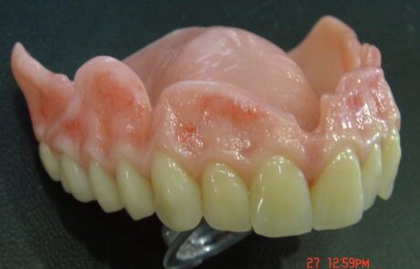 Prótesis dental