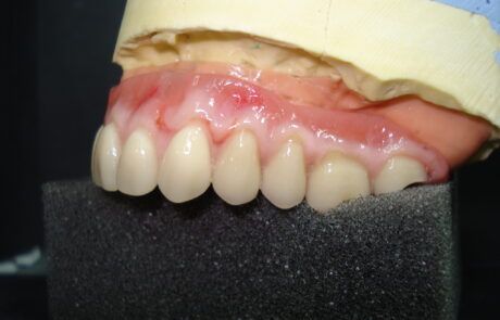 Prótesis dental