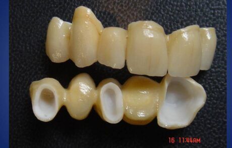 Prótesis dental
