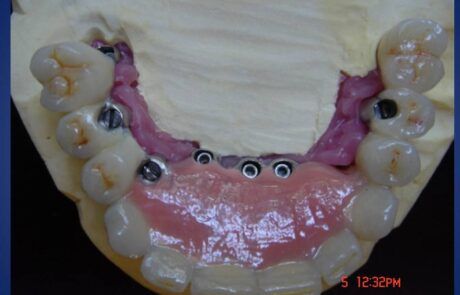 Prótesis dental