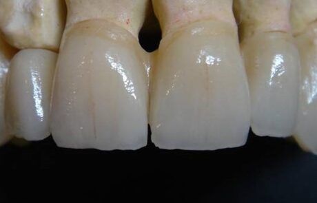 Prótesis dental